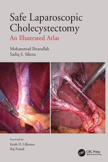 Safe Laparoscopic Cholecystectomy An Illustrated Atlas 1 Editoin