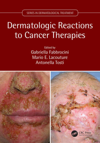 Dermatologic Reactions To Cancer Therapies, 1E.
