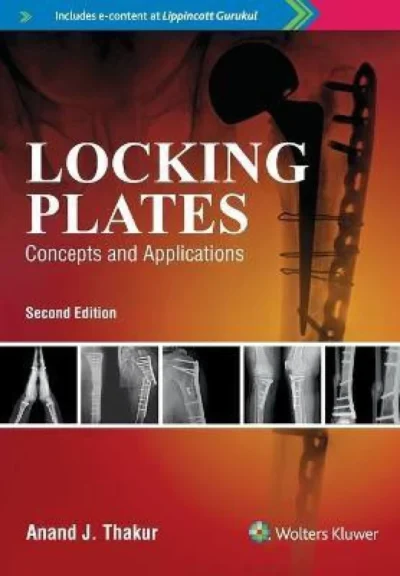 Locking Plates Concepts And Applications 2e
