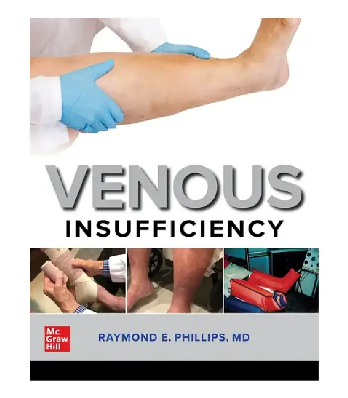 Venous Insufficiency