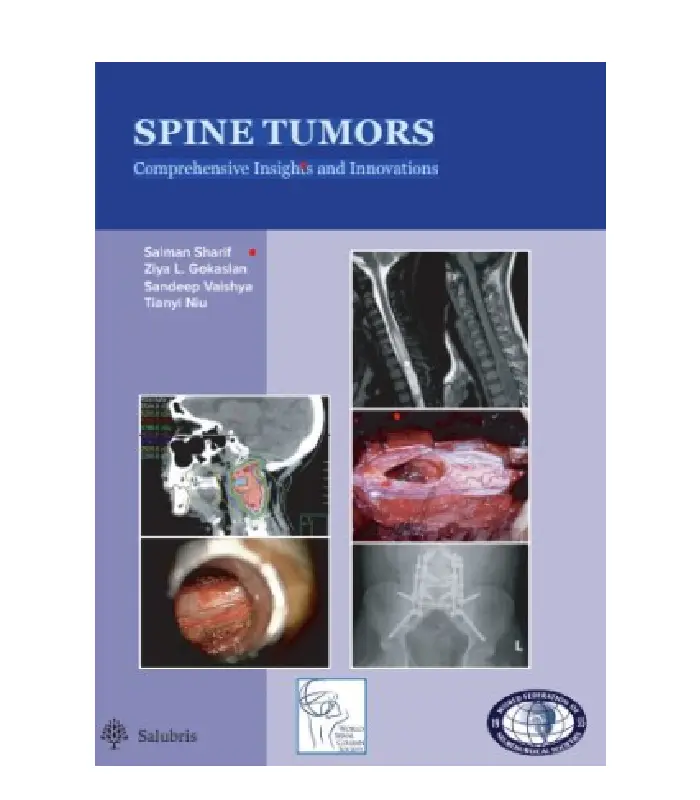 Spine Tumors Comprehensive Insights and Innovations