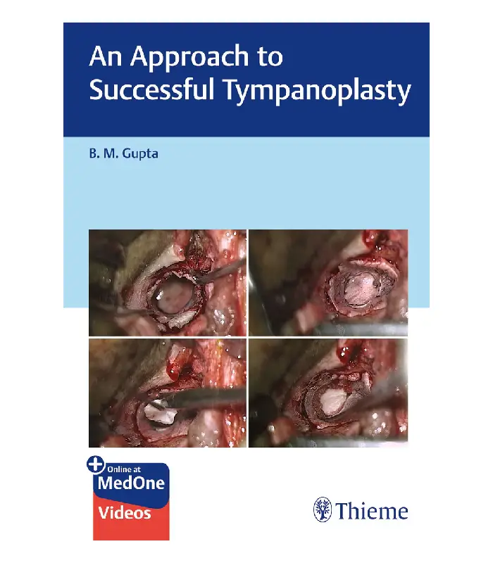 An Approach to Successful Tympanoplasty