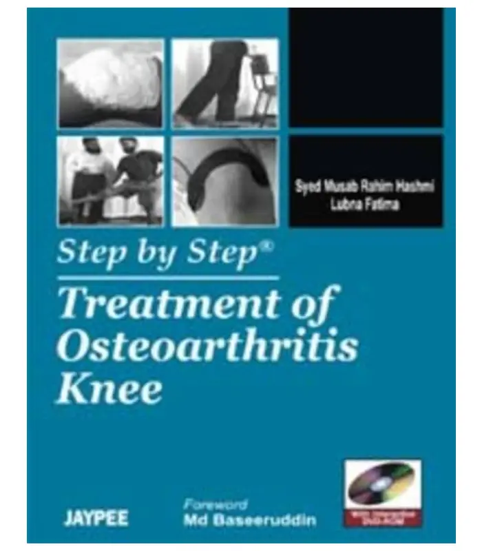 Step by step Treatment of Osteoarthritis Knee 1Ed